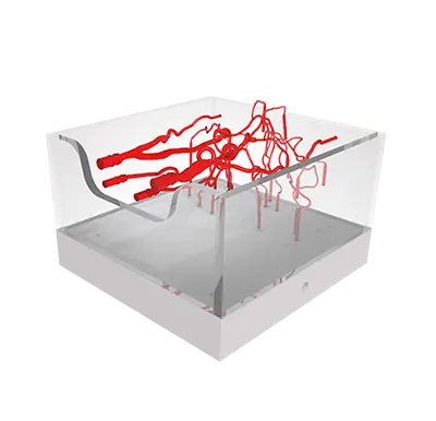 willis circle aneurysm